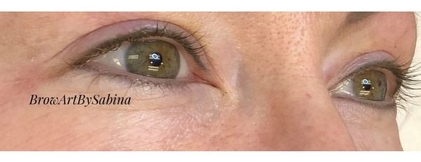 Get Smooth Skin with One Syringe of Bellafill