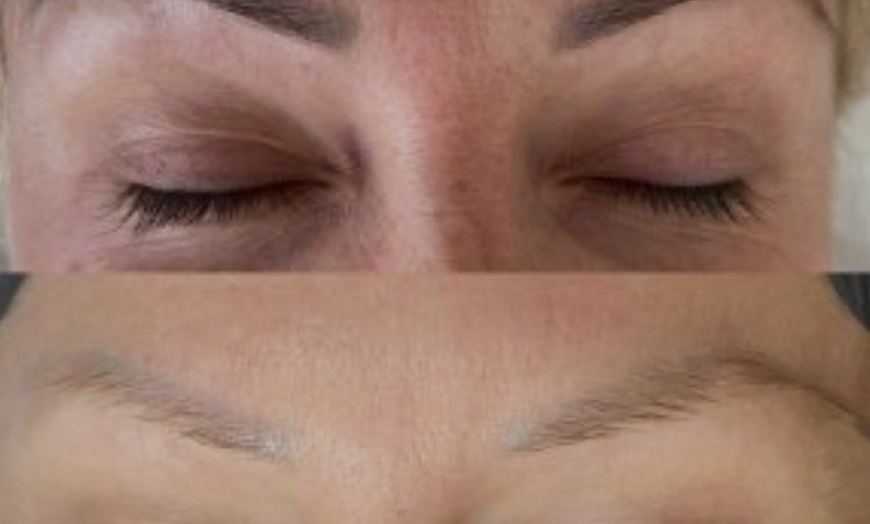 Image 3: Eyebrow Tattoo Removal: Save Up to 30% Off at MB Advanced Beauty MED!