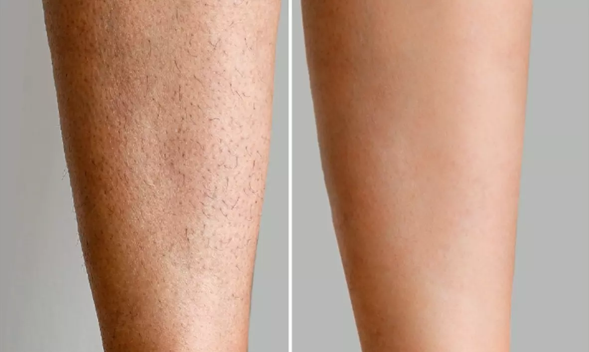 Six Laser Hair-Removal Treatments on a S, M & More Areas 91%