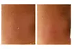 Discover Skin Care New York's effective skin tag, mole, and spot removal with laser tech, offering up to 50% off. - Second Medium