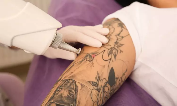 6 or 8 (30 Minutes) Laser Tattoo Removal Sessions for Smooth Skin