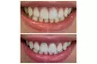 Get Phillips Zoom Whitening! Teeth Whitening at Verma Cosmetic & Family Dentistry (Up To 60% Off) - Second Medium