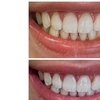 Image 1: Get a Brighter Smile with Phillips Zoom Whitening! Teeth Whitening
