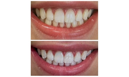 Phillips Zoom Whitening! Teeth Whitening - Verma Cosmetic And Family Dentistry