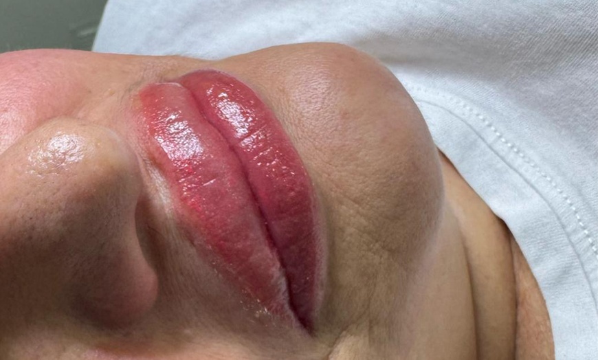 Image 1: Hidratación de labios efecto volumen con hyaluron pen