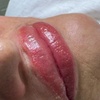 Image 1: Hidratación de labios efecto volumen con hyaluron pen