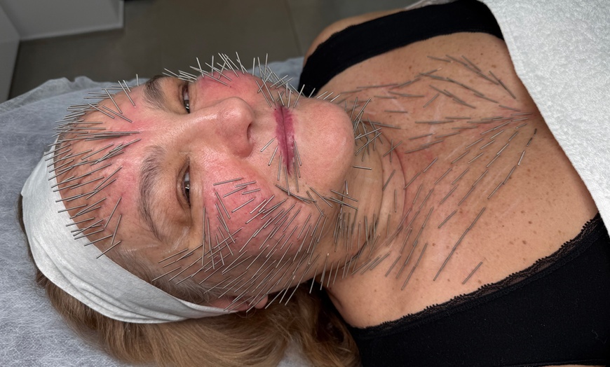 Image 3: Needle Shaping: lifting bez skalpela na twarz, szyję i dekolt 