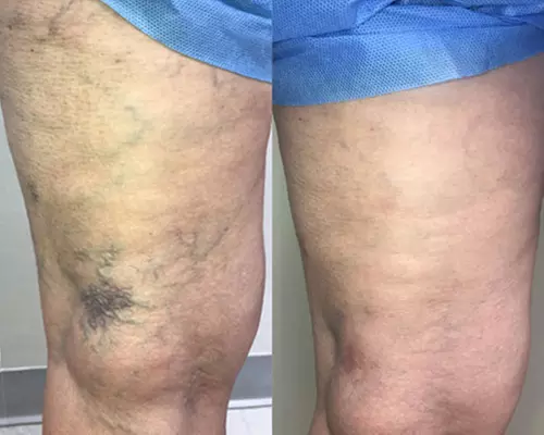 Discover Non-Invasive Spider Vein Consultation and Treatment