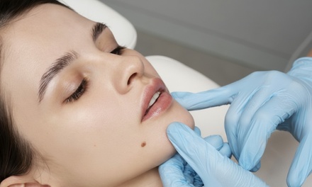 Infiltración de 1 vial de tratamiento facial de relleno dérmico - Clínica Dental y Salud Valencia