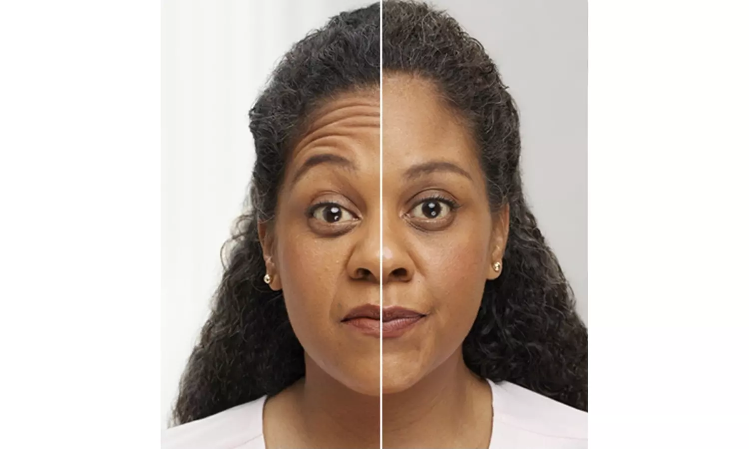 Smooth Fine Lines with 20, 40 or 60 Units of Botox  