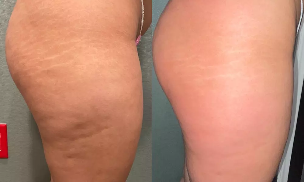 Smooth Skin with One or Three CelluClear Therapy Sessions