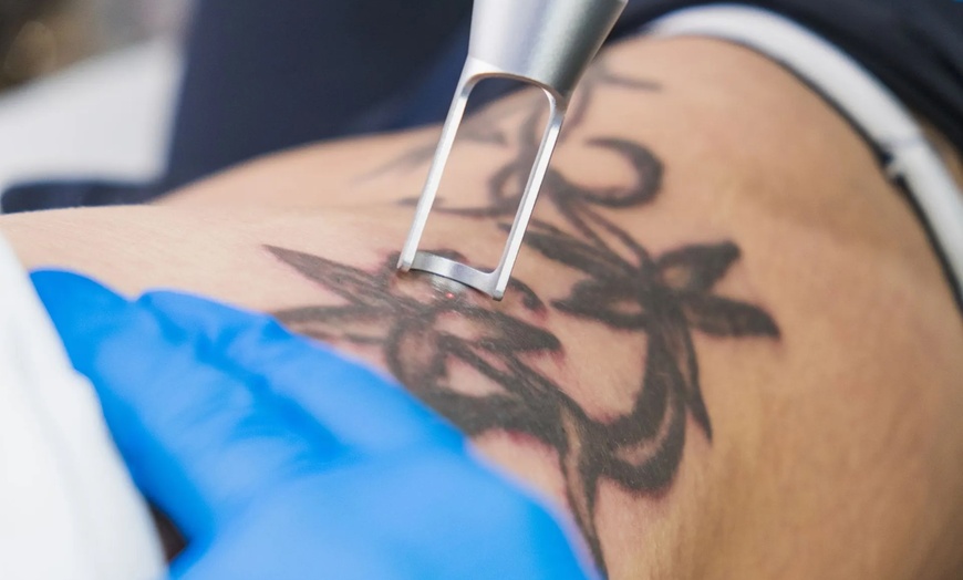 Image 6: 3 Sessions of Laser Hair Removal for a Small, Medium, or Large Area
