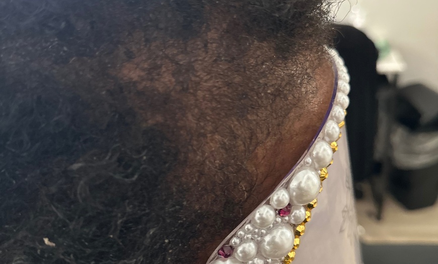 Image 5: Scalp Analysis and Hair Restoration Consultations