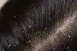 Revitalize Your Hair with Microscopic Analysis and Scalp Detox at Drstrandz ( Up to 50% Off ) - Second Medium