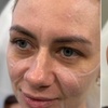 Image 5: Revanesse Versa Dermal Filler: Natural Lip & Facial Enhancement