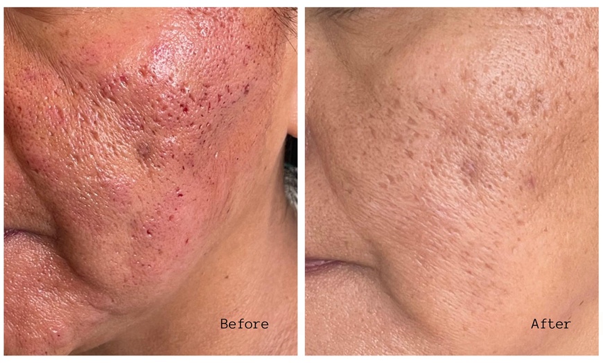 Image 7: One or Three Sessions of Microneedling with/without LED Light Therapy