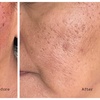 Image 7: One or Three Sessions of Microneedling with/without LED Light Therapy