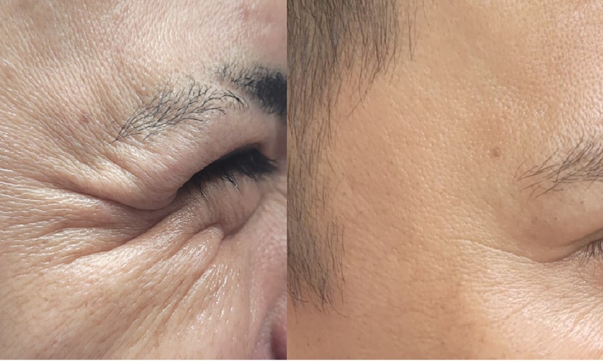 Image 6: Get Refreshed with 20, or 40 Units of Xeomin Injections 