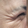 Image 6: Get Refreshed with 20, or 40 Units of Xeomin Injections 