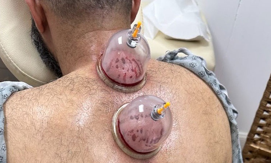 Image 3: 20-Minute 1, 3, or 5 Combination Cupping Sessions: (Wet, Dry & Moving)