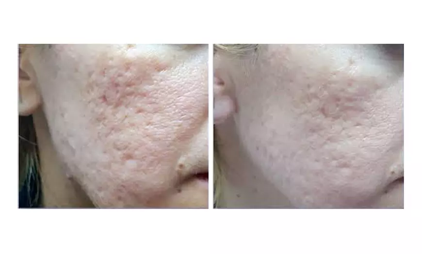 Image 4: One, Two, Three or Four Sessions of Micro-needling - Full Face