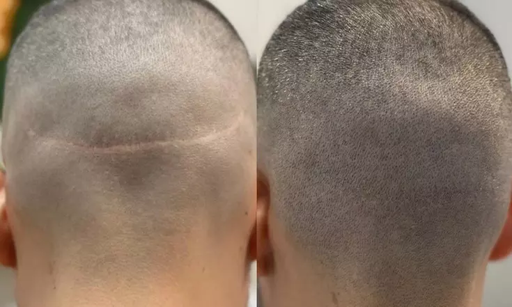 Scalp Micropigmentation Hair Loss, Balding, or Thinning Treatment