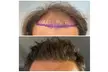 Full Hair Restoration with Up to 3000-Graft FUE Transplant for a Seamless, Natural Look (Up to 33% Off) - Second Medium
