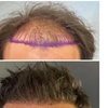 Image 5: Natural-Looking Hair Restoration with Up to 3000-Graft FUE Transplant