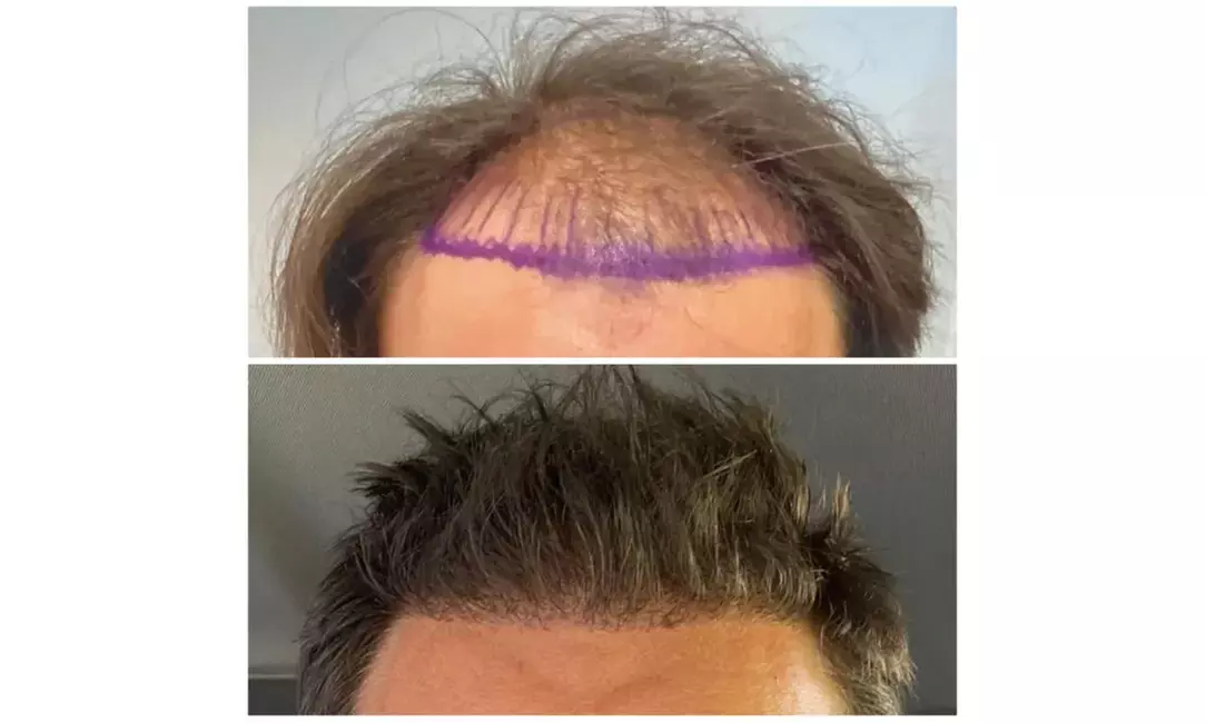 Natural-Looking Hair Restoration with Up to 3000-Graft FUE Transplant
