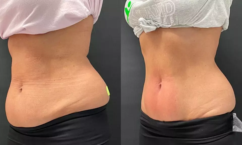 Achieve a Toned Look with Body Sculpting, Non-Cellulite Treatment 