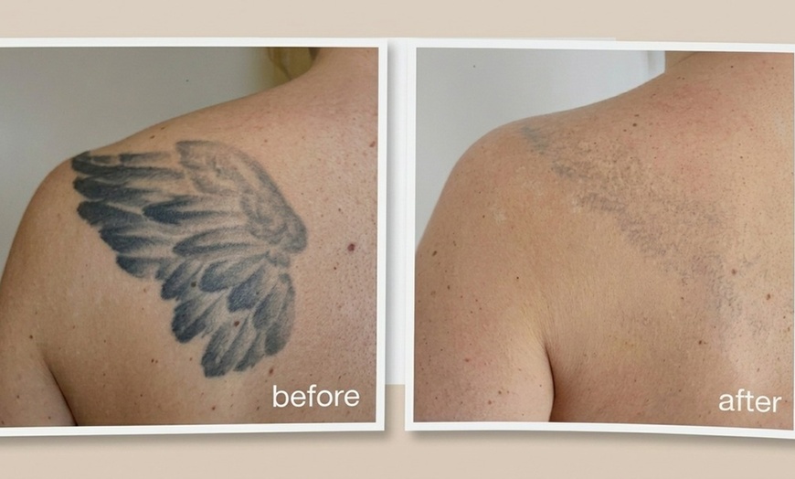 Image 5: 3 Laser Tattoo Removal Sessions: Small, Medium, Large or XL Areas
