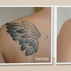 Image 5: 3 Laser Tattoo Removal Sessions: Small, Medium, Large or XL Areas