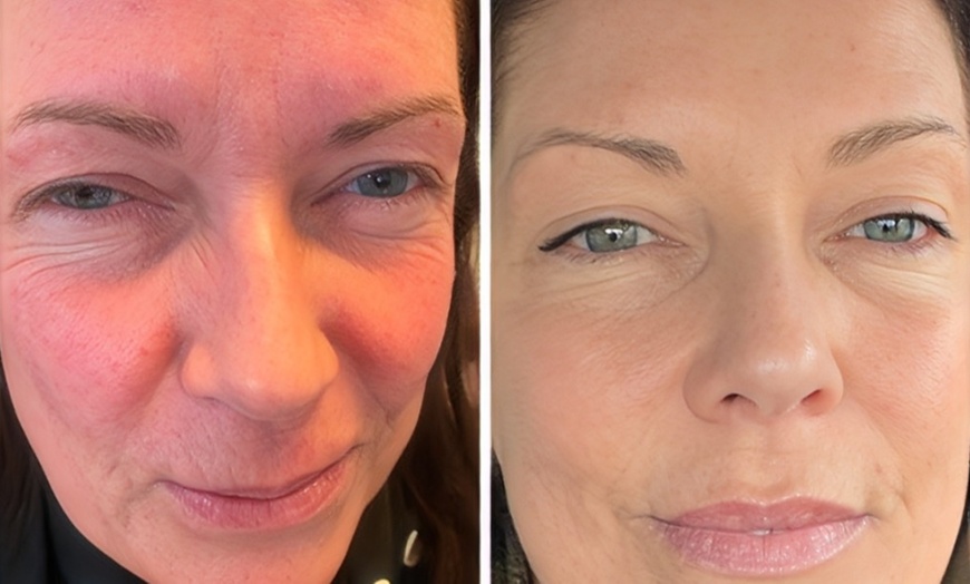 Image 2: Achieve Youthful with Wrinkle Reduction for 1, 2 or 3 Areas 