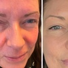 Image 2: Achieve Youthful with Wrinkle Reduction for 1, 2 or 3 Areas 