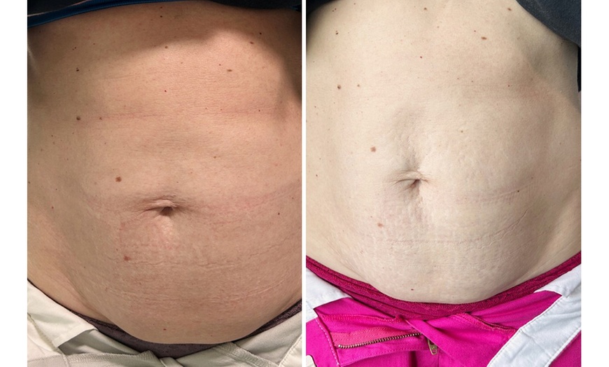 Image 2: RF Skin Tightening & Ultrasonic Cavitation