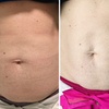 Image 2: RF Skin Tightening & Ultrasonic Cavitation