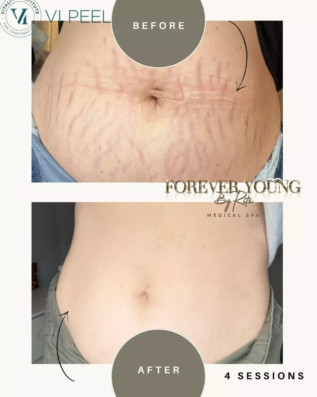 One Light or Intense Mode CO2 Laser Resurfacing Treatment for Full Face at Forever Young by Rita (Up to 55% Off)