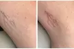 1 or 2 Spider Vein/Cluster Removal Treatment with Consultation/ Dark Spot Treatment Small Area (Up to 45% Off) - Second Medium
