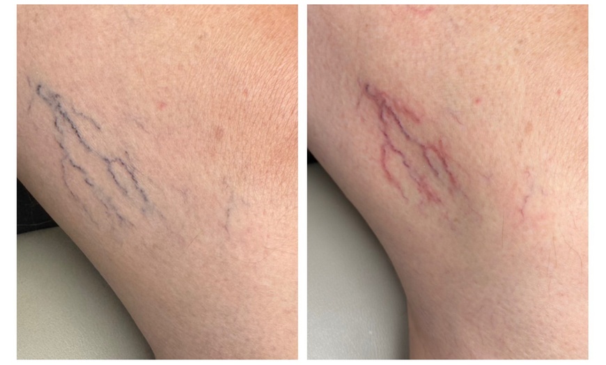 Image 3: One or Two Spider Vein/Cluster Removal Treatment with Consultation