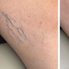 Image 2: One or Two Spider Vein/Cluster Removal Treatment with Consultation