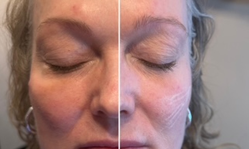 Image 2: Rejuvenate Your Skin with Erbium Laser for Face and Neck