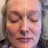 Image 2: Rejuvenate Your Skin with Erbium Laser for Face and Neck