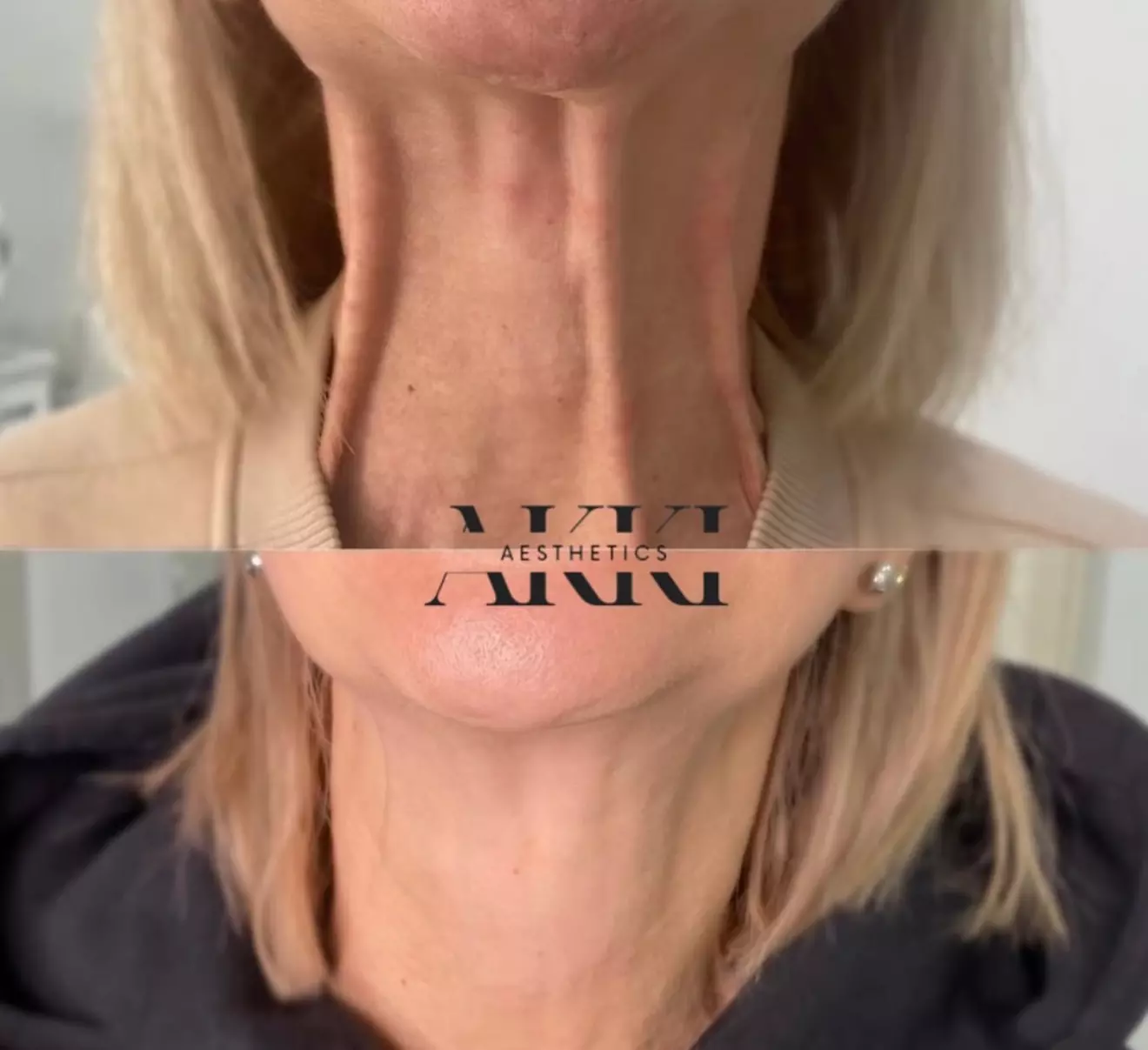 Enhance Your Look with 20, 40, or 60 Units of Botox