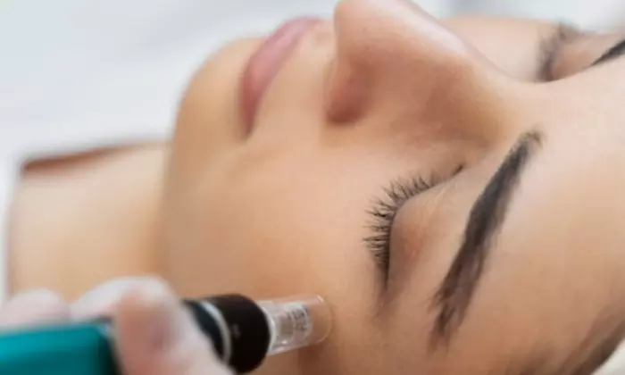 Radiant Skin Awaits with One, Two, or Three Microneedling Sessions at Derm One Beauty (Up To 60% Off) - Primary Image
