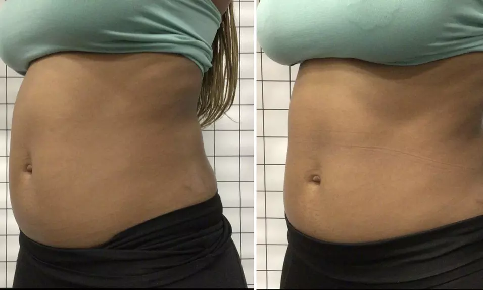 1, or 2 Muscle Building Body Sculpting Session for Abdomen or Buttocks