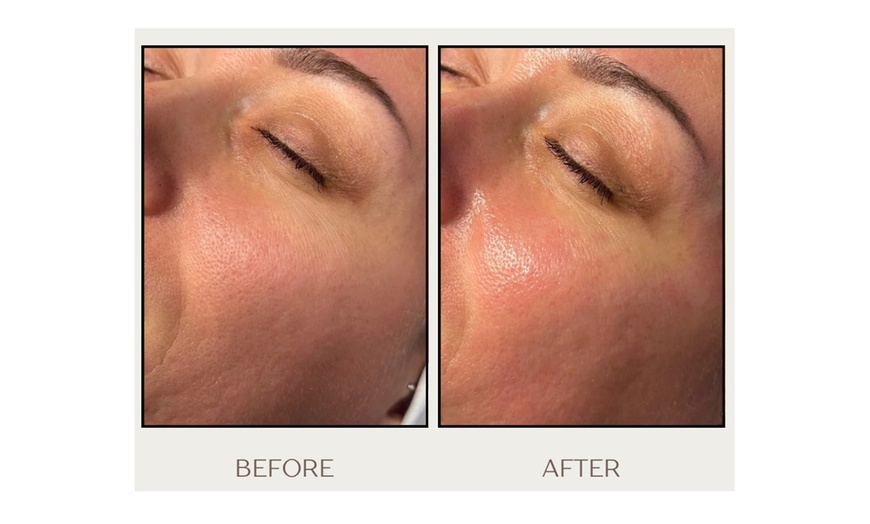 Image 2: Custom or Vox++ Hydrafacial w/ Lymphatic Face and Neck Massage Options