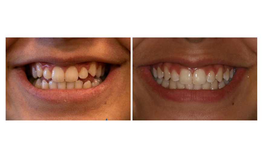 Image 3: Clear Aligner Orthodontic Treatment