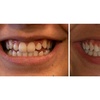 Image 3: Clear Aligner Orthodontic Treatment