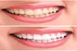 Professional 3D Teeth Whitening Kit with Remineralization Gel - 1 or 2 pack | Dental-Quality Results & 5-Day Shipping - Second Medium