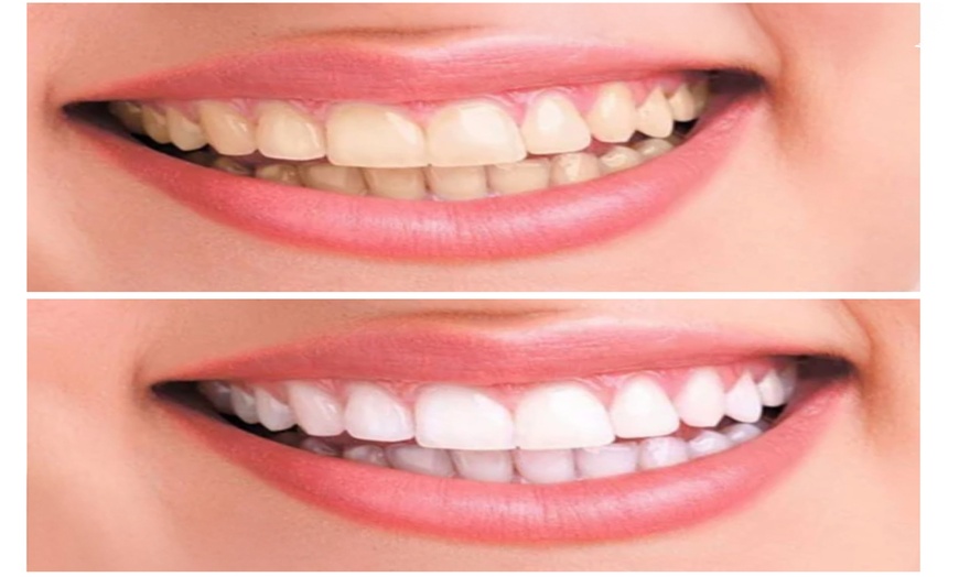 Image 2: Professional 3D Teeth Whitening Kit w Remineralization Gel: 1 & 2 pack